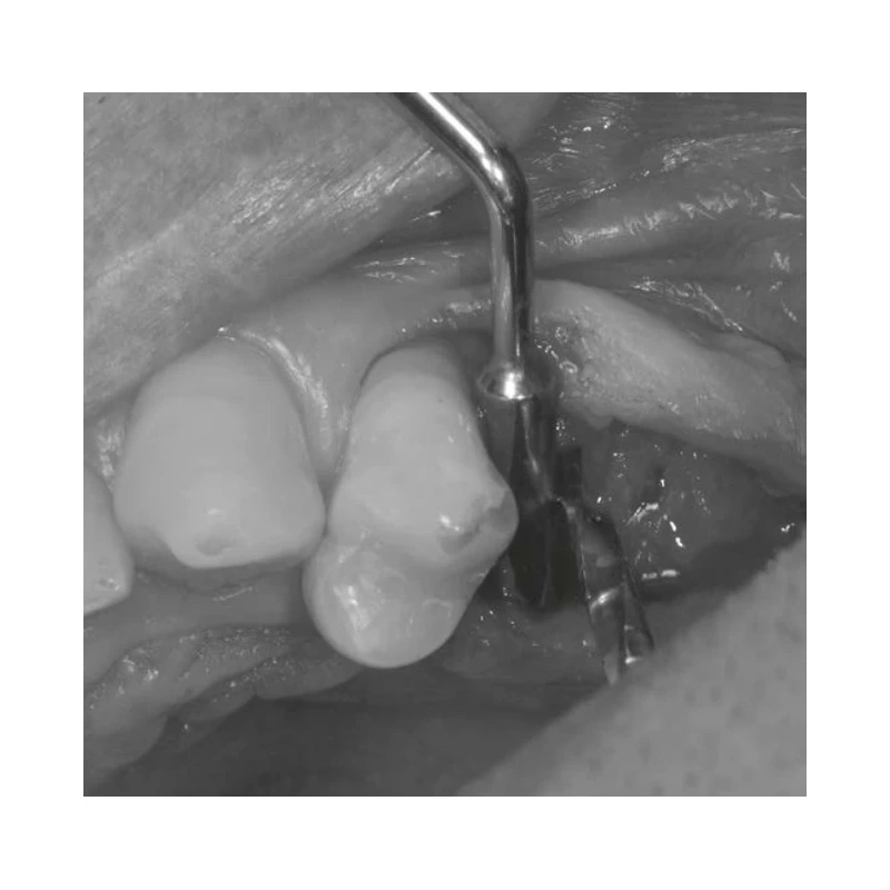 LM Implant Misura MR 3.1-5.3 - инструмент для позиционирования имплантатов | LM-Instruments Oy (Финляндия)