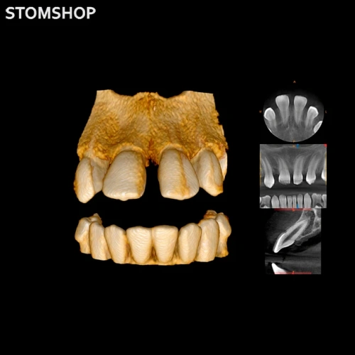 CS 8100 3D - дентальный трехмерный томограф, FOV 8х9 см | Carestream Dental (США)