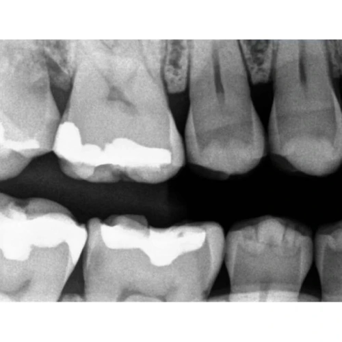 Kodak RVG 5200 - радиовизиограф, 16 пар линий/мм | Carestream Dental (США)