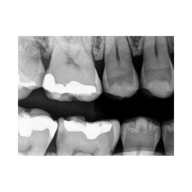 Kodak RVG 5200 - радиовизиограф, 16 пар линий/мм | Carestream Dental (США)
