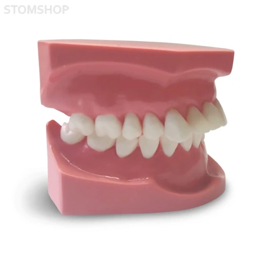 ORB03 – ортодонтическая модель с брекетами и твердой десной, 2 класс | GF Dental (Италия)