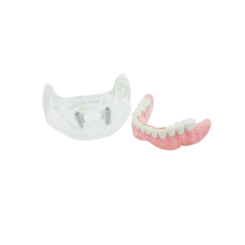 T11 – демонстрационная модель нижней челюсти с имплантами | GF Dental (Италия)