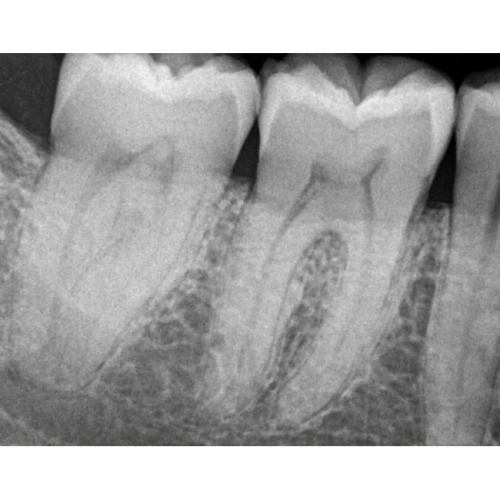 Kodak RVG 6200 - радиовизиограф, 24 пар линий/мм | Carestream Dental (США)