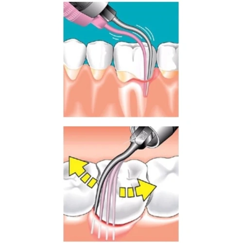 Sonicflex paro №62 A - насадка с рабочим концом, изогнутым вправо с закругленной верхушкой для минимально инвазивной терапии пародонтита | KaVo (Германия)