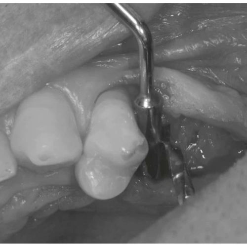 LM Implant Misura MR 3.0-5.0 - инструмент для позиционирования имплантатов | LM-Instruments Oy (Финляндия)