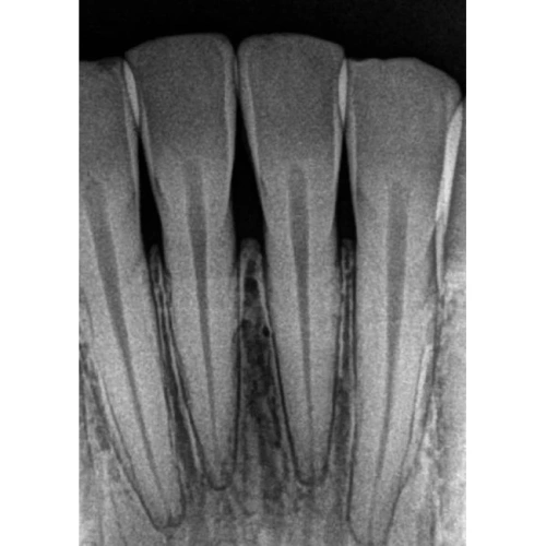 Kodak RVG 5200 - радиовизиограф, 16 пар линий/мм | Carestream Dental (США)