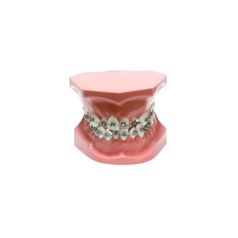 ORB02 – ортодонтическая модель с брекетами и твердой десной, 1 класс | GF Dental (Италия)
