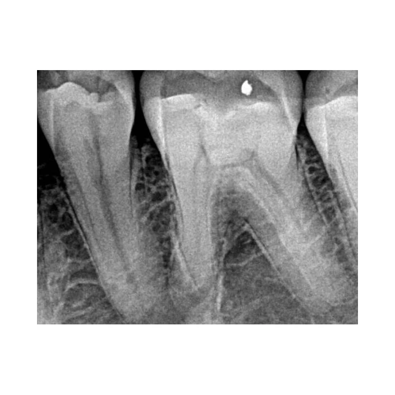 Kodak RVG 5200 - радиовизиограф, 16 пар линий/мм | Carestream Dental (США)
