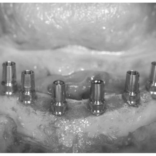 LM Implant Misura MR 3.4-5.8 - инструмент для позиционирования имплантатов | LM-Instruments Oy (Финляндия)