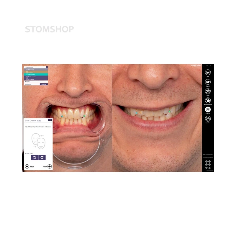 Exocad Smile Creator - модуль для планирования улыбки | Exocad (Германия)
