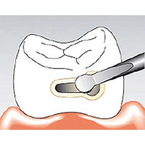 Sonicflex bevel №59 - насадка для минимально инвазивной терапии кариеса с алмазным покрытием, дистальная | KaVo (Германия)